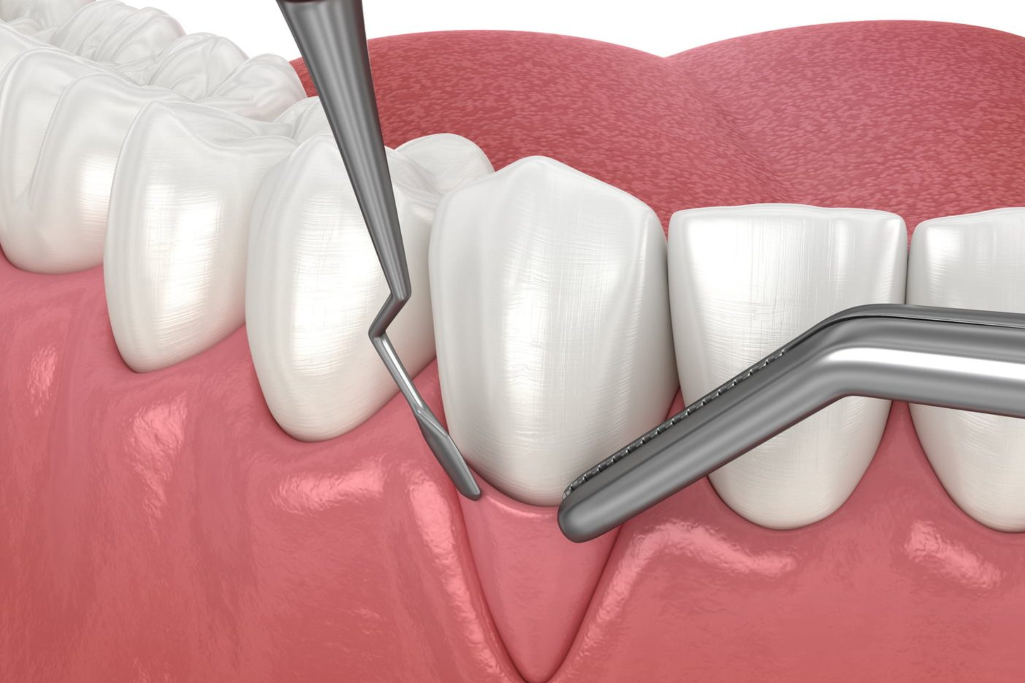 Periodontal Procedures in Yerawada | Le Dental Esthetique