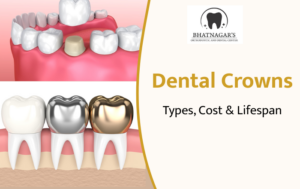 Complete Guide to Dental Crowns: Types, Cost & Lifespan