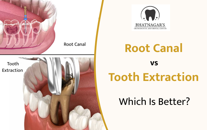 Tooth Extraction For Roots Root Canal vs Tooth Extraction – Which Is Better? - Bhatnagar ...