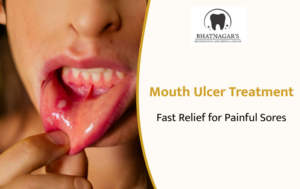 Mouth Ulcer Treatment Fast Relief for Painful Sores