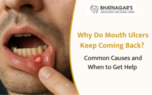 Why Do Mouth Ulcers Keep Coming Back? Common Causes and When to Get Help